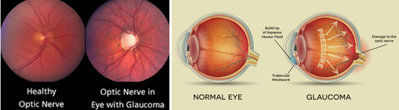 Glaucoma